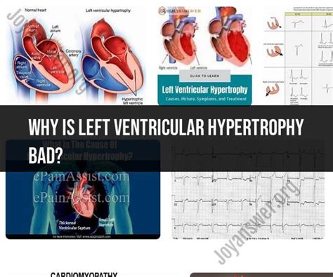 Dangers of Left Ventricular Hypertrophy .